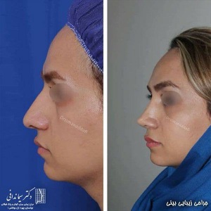 جراحی-بینی-219