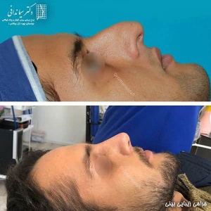 جراحی-بینی-220