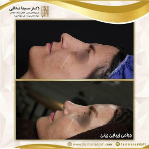جراحی-بینی-222
