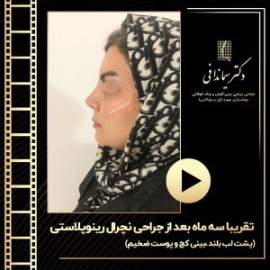 جراحی-بینی-224