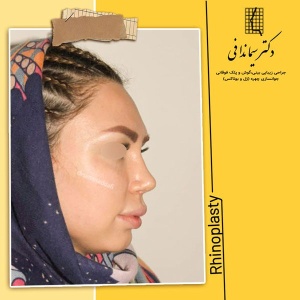 جراحی-بینی-227