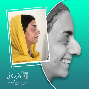 جراحی-بینی-231