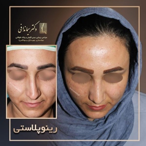 جراحی-بینی-240