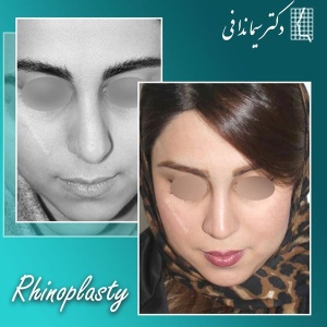 جراحی-بینی-262