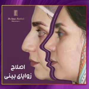 جراحی-بینی-285