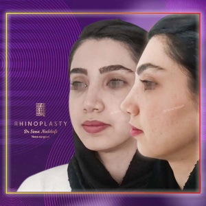 جراحی-بینی-287