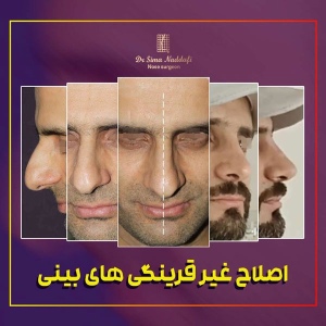 جراحی-بینی-288