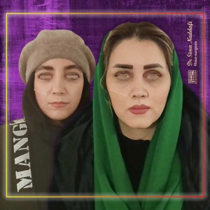 جراحی-بینی-289