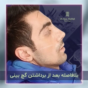 جراحی-بینی-299
