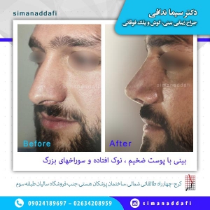 جراحی-بینی-3