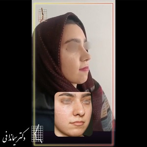 جراحی-بینی-306