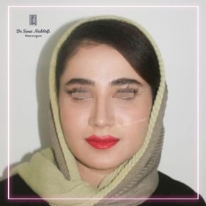 جراحی-بینی-308