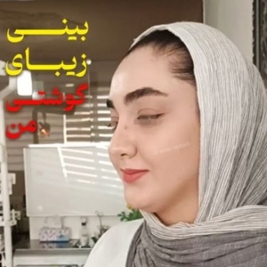 جراحی-بینی-309