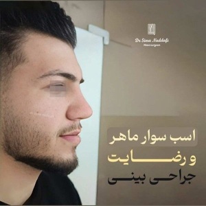 جراحی-بینی-310