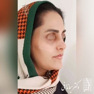 جراحی-بینی-322