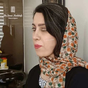 جراحی-بینی-323
