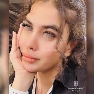 جراحی-بینی-325