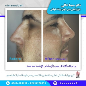 جراحی-بینی-4