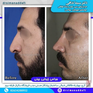 جراحی بینی 51-min