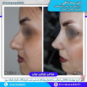 جراحی بینی 52-min