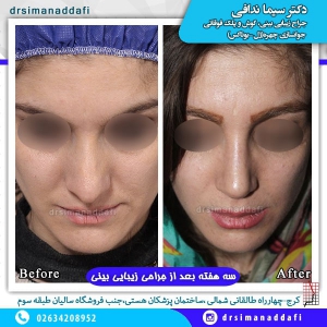 جراحی بینی 53-min