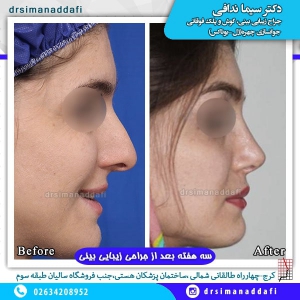 جراحی بینی 54-min