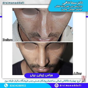 جراحی بینی 55-min