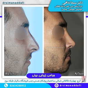 جراحی بینی 56-min