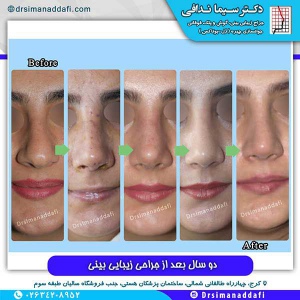 جراحی-بینی-57