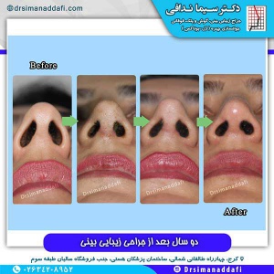 جراحی-بینی-58