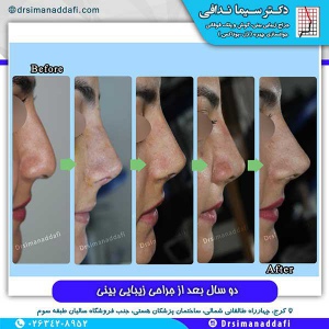 جراحی-بینی-59