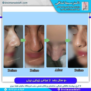 جراحی-بینی-60