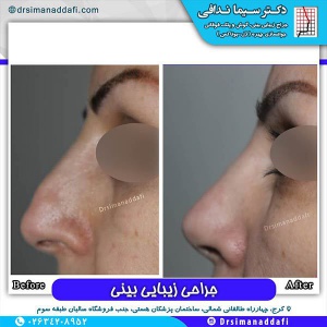 جراحی-بینی-62