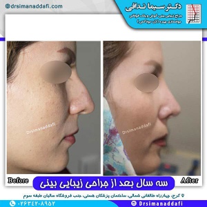 جراحی-بینی-63