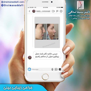 جراحی-بینی-64
