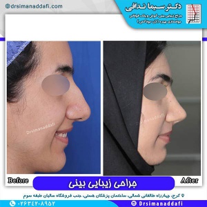 جراحی-بینی-65