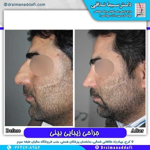 جراحی-بینی-66