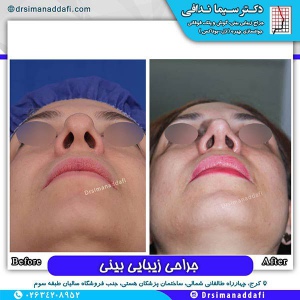 جراحی-بینی-67