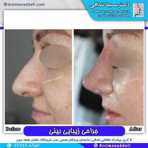 جراحی-بینی-68