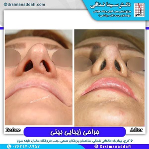 جراحی-بینی-69