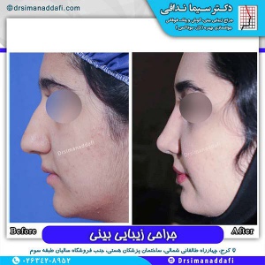 جراحی-بینی-71