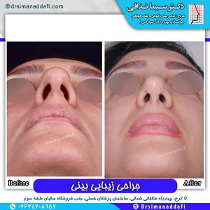 جراحی-بینی-72