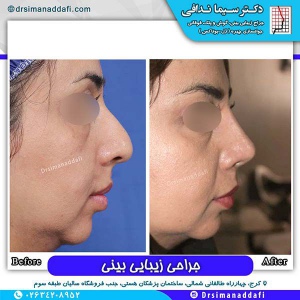 جراحی-بینی-73