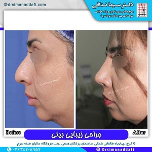 جراحی-بینی-74