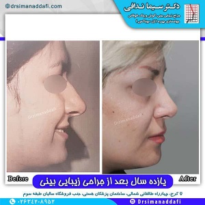 جراحی-بینی-75