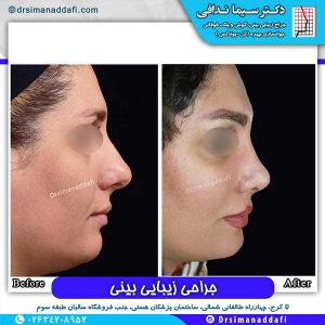 جراحی-بینی-77