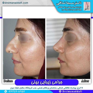 جراحی-بینی-79