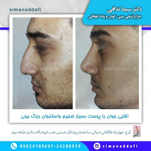 جراحی-بینی-8