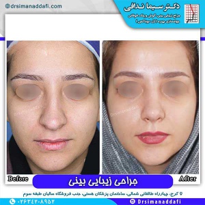 جراحی-بینی-82