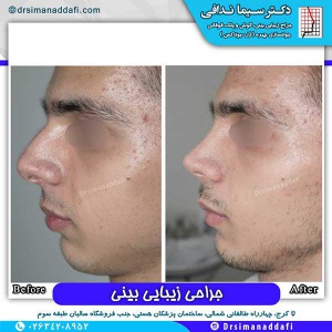 جراحی-بینی-83